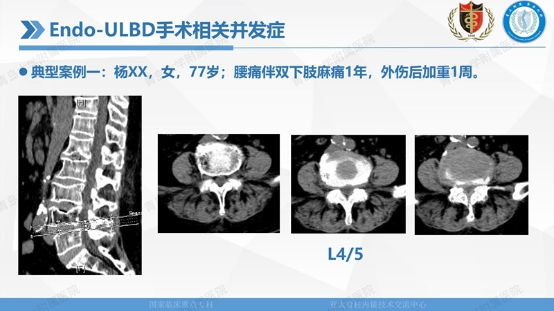1. ULBD技术体系构建及临床应用 2023.4.5 - 15min_123.jpg