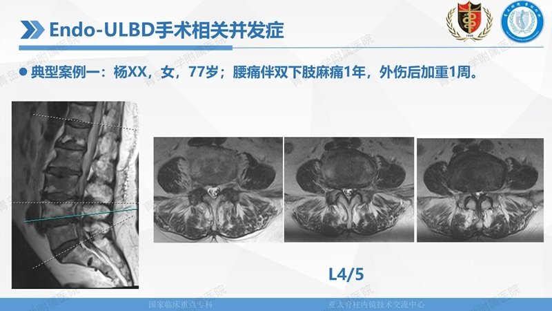 1. ULBD技术体系构建及临床应用 2023.4.5 - 15min_126.jpg