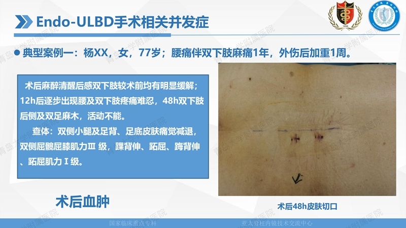 1. ULBD技术体系构建及临床应用 2023.4.5 - 15min_128.jpg