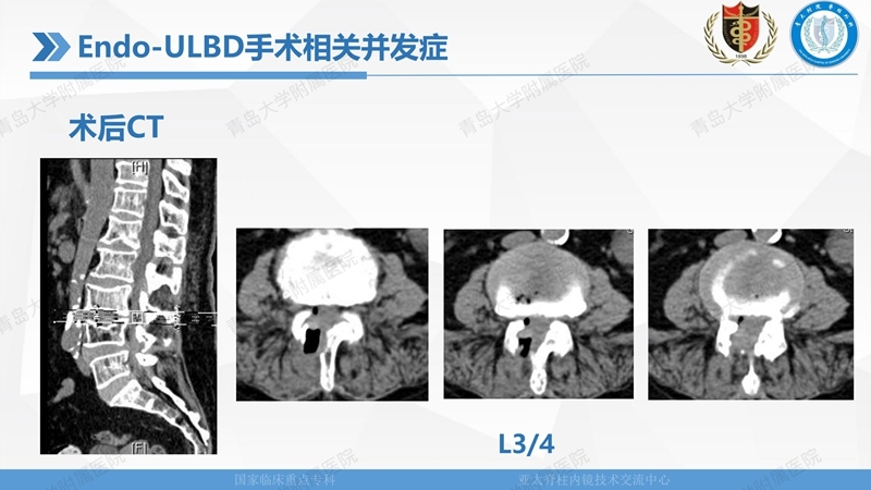 1. ULBD技术体系构建及临床应用 2023.4.5 - 15min_131.jpg