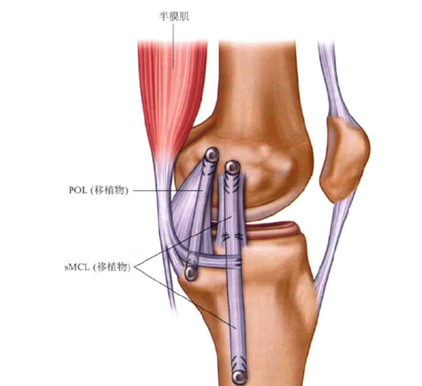 内侧副韧带损伤表现图片